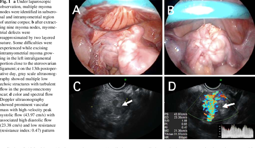 a-Under-laparoscopic-observation-multiple-myoma-nodes-were-identiWed-in-subserosal-and